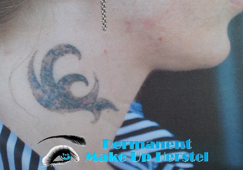 Tattoo verwijderen in de nek 2